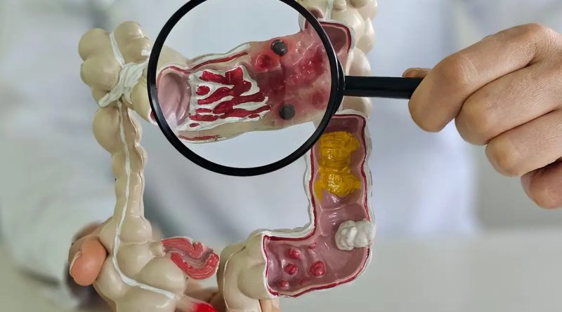 Doença intestinal cresce cinco vezes em 13 anos no Brasil